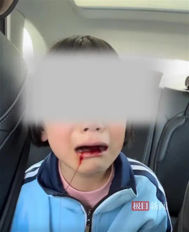 小学一年级女孩被同学打得满口流血，家长“不追究”，法律不可放过